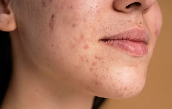 Acne-Prone or Irritated Skin