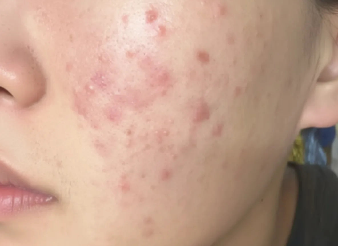 "Redness and flare-ups have finally started to fade."