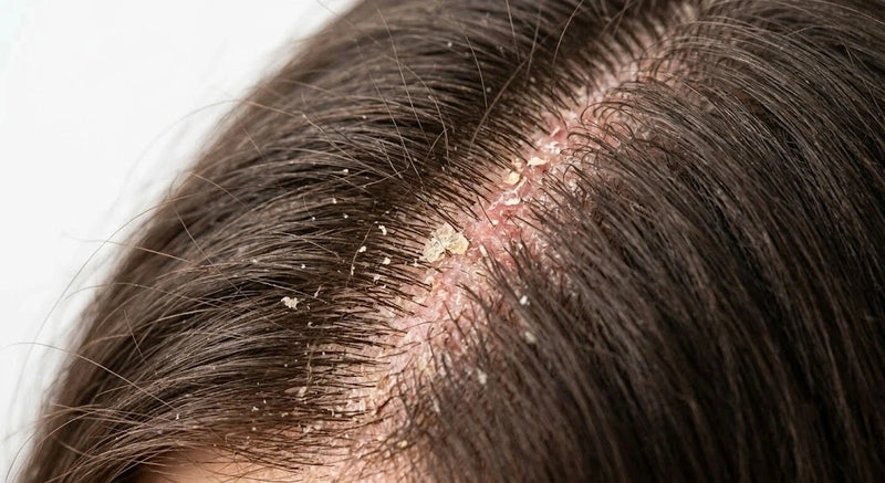 Dry Scalp