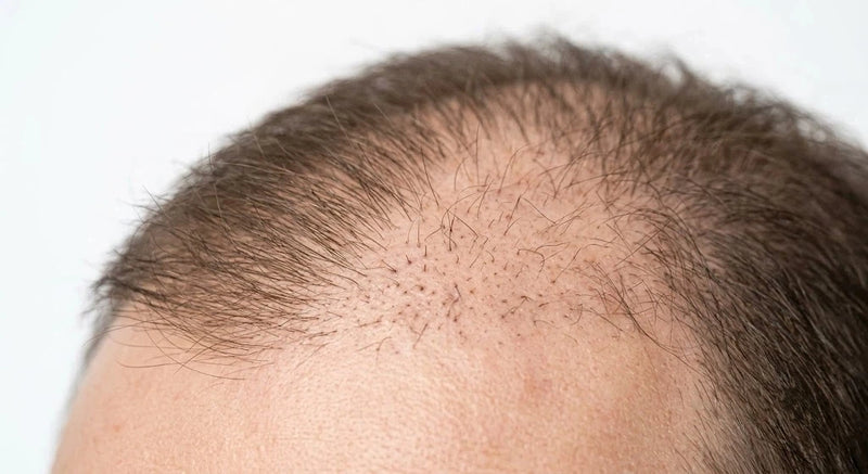 Slow Hair Growth