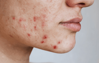 Acne-prone & Sensitive